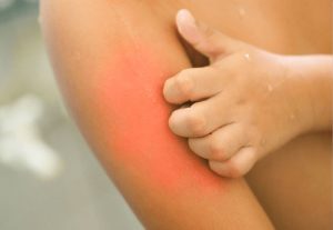 Dermatitis - Clínica de alergias