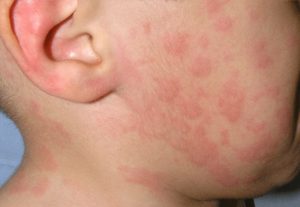 Urticaria Clínica de alergias
